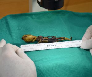 Tiny skeleton was girl with bone disease